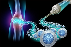 Arthrosamid: What Patients Should Know About the New Knee Injection Making Headlines